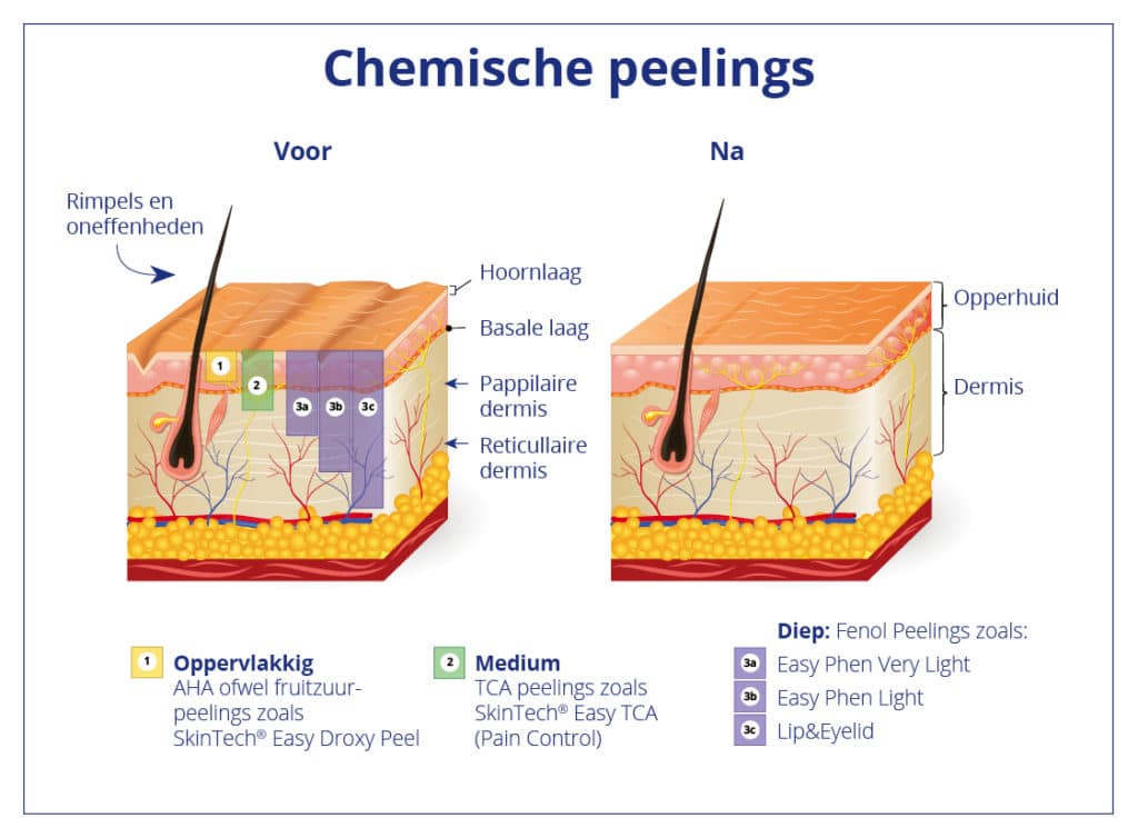 Esspecially for you Chemisch Medisch Peeling